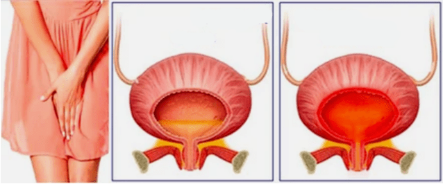 Cistitis crónica