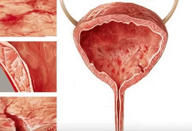 Las razones para el desarrollo de la cistitis en las mujeres