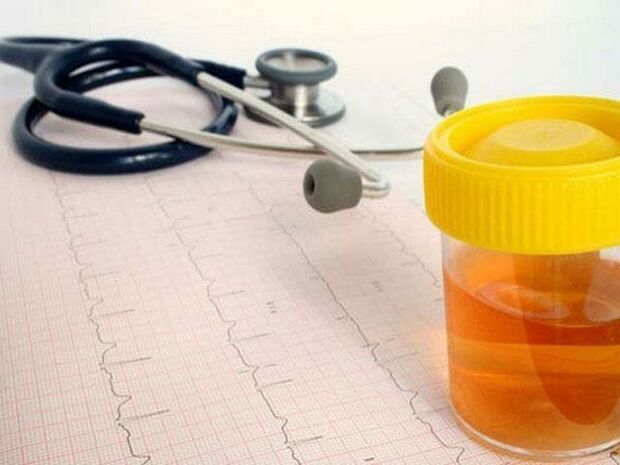 análisis de orina para diagnosticar cistitis